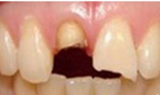 牙齿缺损的修复方法 ，要及时的治疗