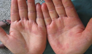 湿疹怎么治 手部湿疹解决办法